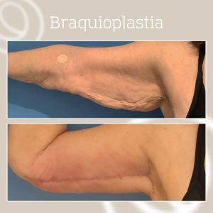 Tractament per a la flacciditat corporal del braç, braquioplàstia amb Argo Plasma, abans i després a les 4 setmanes