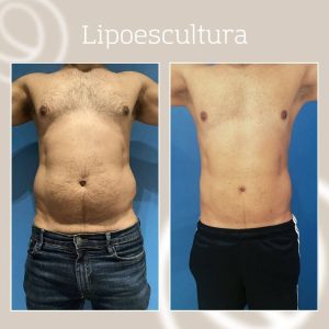 Antes y después lipoescultura abdomen y flancos en hombre con Argo Plasma y otras técnicas