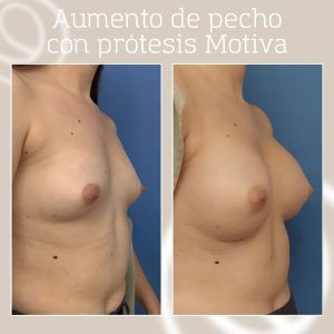 Aumento de pecho con prótesis Motiva ergonomix2 antes y después