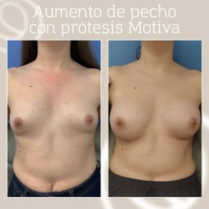 Breast augmentation Barcelona with ergonomic Motiva implants before and after