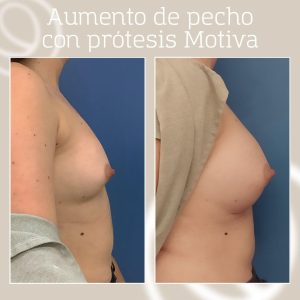 Implantes ergonómicos Motiva antes y después