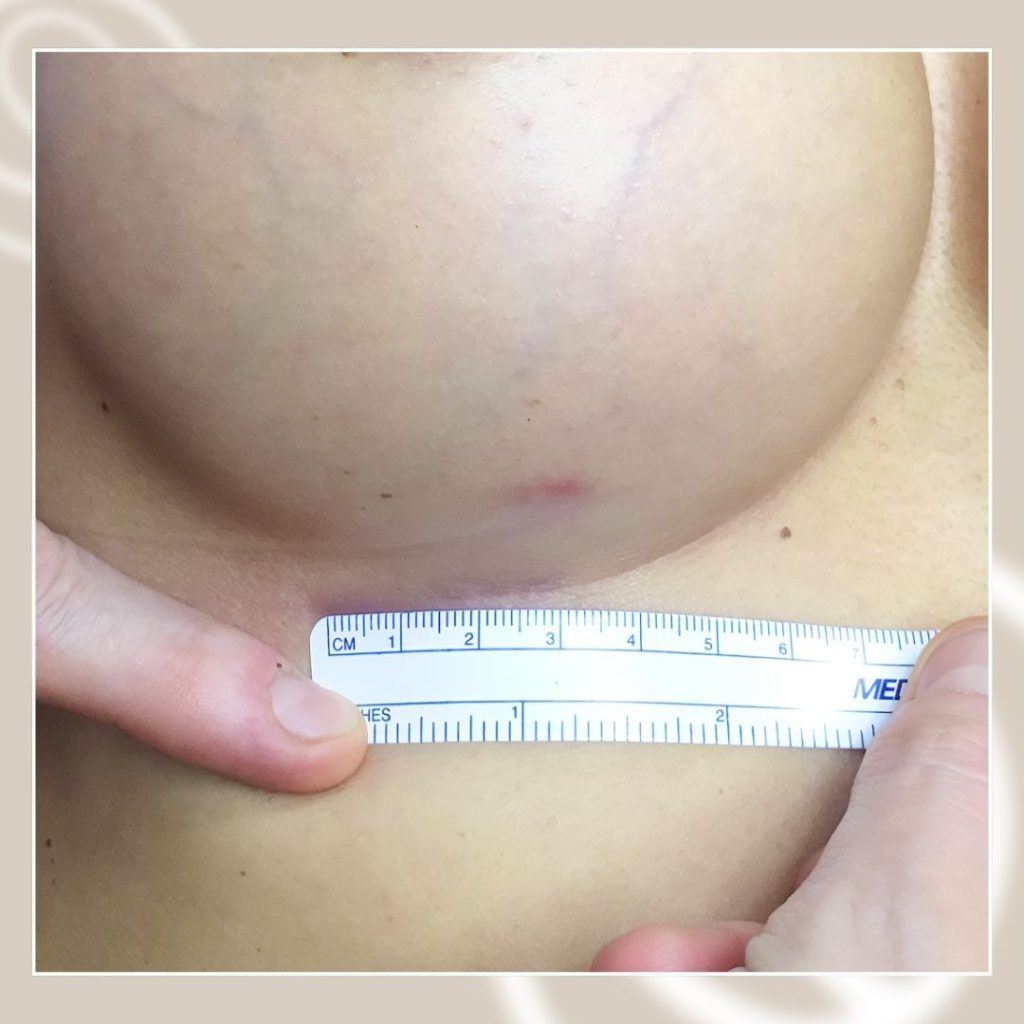 Undermammary scar after breast augmentation operation in Barcelona