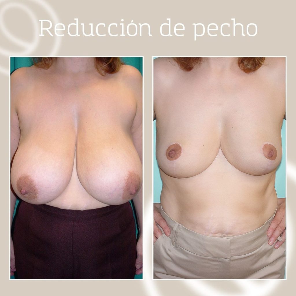 Breast reduction operation result before and after with inverted T scar